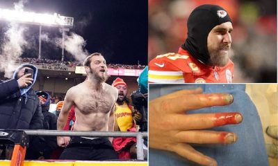 Chiefs Fans need amputation